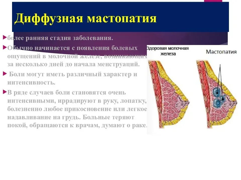 Диффузионная фиброзно-кистозная мастопатия. Фиброзно-кистозная ткань молочной железы. Мастопатия молочной железы мастит. Диффузная кистозная мастопатия - мастопатия. Диффузная представители