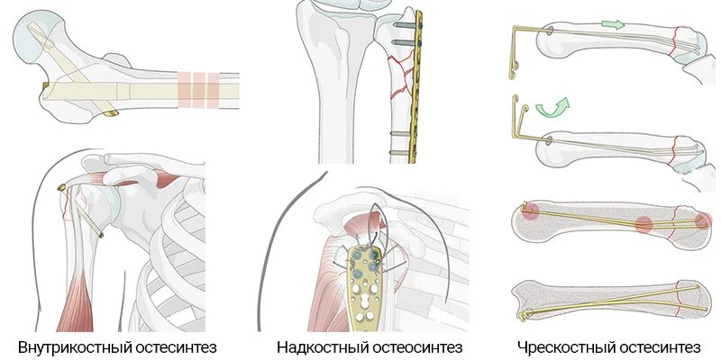 Остеосинтез накостный металлоостеосинтез. Перелом плечевой кости экстрамедуллярный остеосинтез. Погружной накостный остеосинтез. Остеосинтез костей конечностей. Остеосинтез операция пластины