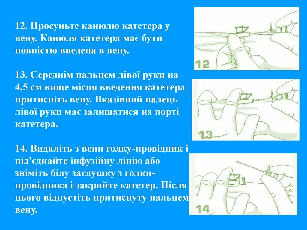 На сколько ставят катетер. Канюля в Вену. Воздух в канюле катетера. Постановка в.в катетера в ценную Вену. Катетер канюля.