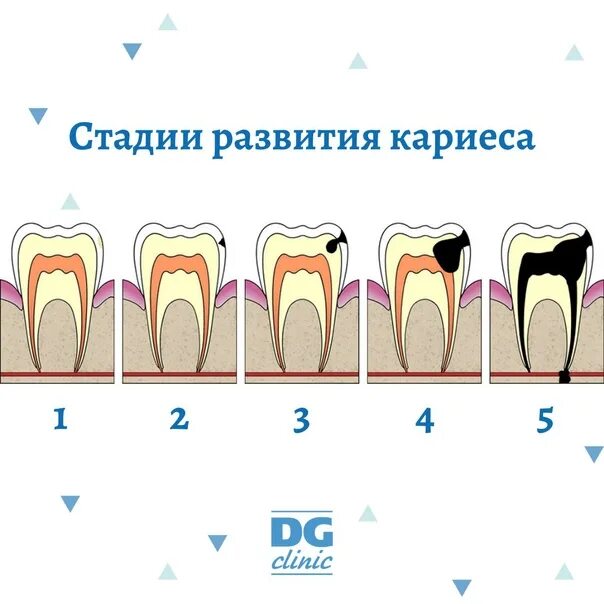Первая стадия. Строение зуба человека кариес. Стадии развития кариеса зубов. Механизм образования кариеса. Стадии развития кариеса для детей.