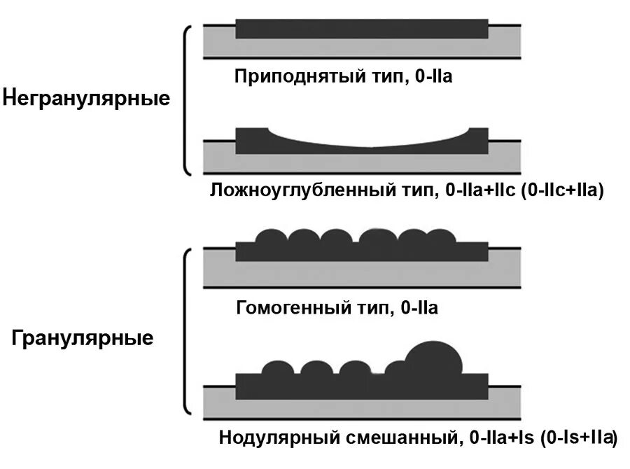 парижская классификация полипов желудка эндоскопическая. парижская классификация эпителиальных образований. классификация полипов эндоскопия. классификация полипов желудка эндоскопическая. парижская классификация полипов желудка эндоскопическая.