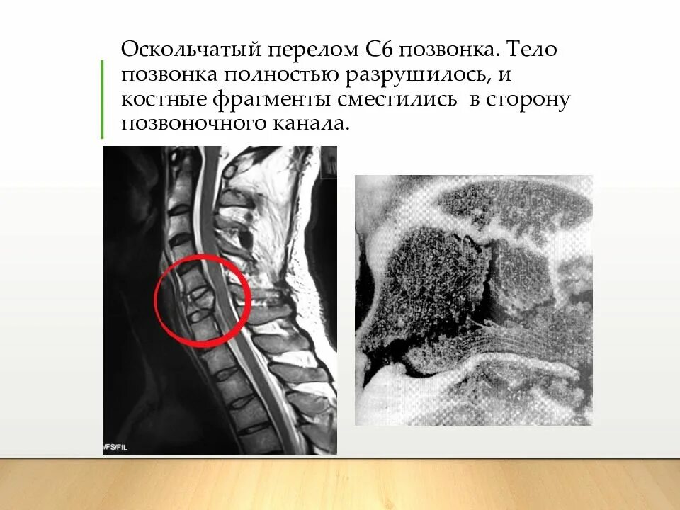 Компрессионно оскольчатый перелом позвонка. Компрессионный оскольчатый перелом позвоночника l1. перелом тела с6 позвонка. перелом тела с1 позвонка. оскольчатый перелом тела с6 позвонка.