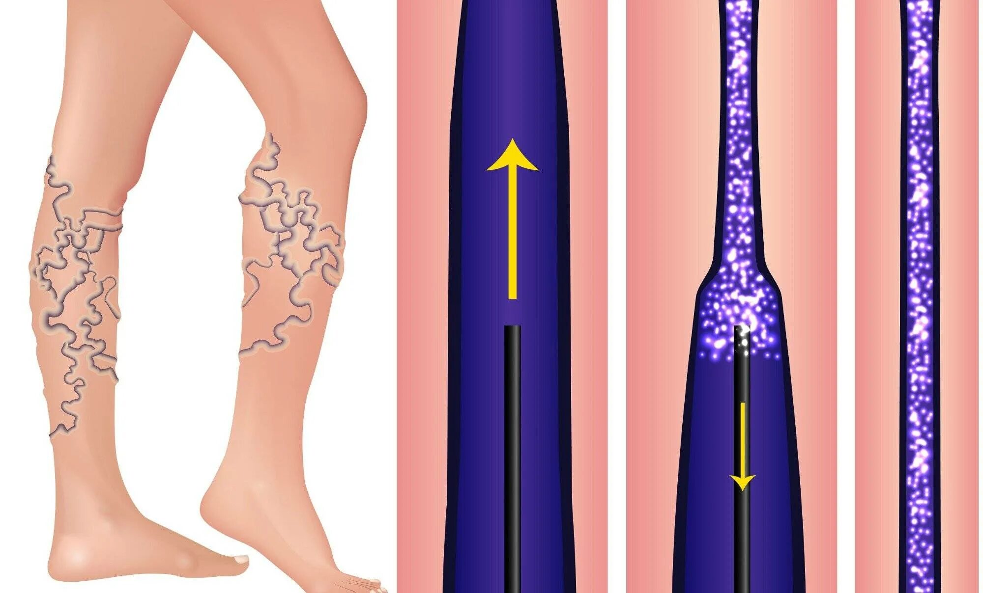 Варикозное расширение вен нижних конечностей склерозирование. Эндовазальная коагуляция вен нижних. Стволовая склеротерапия. Склеротерапия варикозных вен нижних конечностей. Что значат вены на ногах
