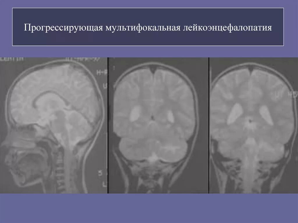 Многоочаговые поражения головного. Прогрессирующая мультифокальная лейкоэнцефалопатия кт. ПМЛ мрт прогрессирующая мультифокальная лейкоэнцефалопатия. Мелкоочаговая лейкоэнцефалопатия. Мультифокальная лейкоэнцефалопатия головного мозга.