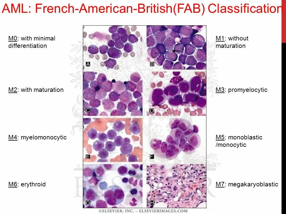 Acute myeloid Leukemia. AML лимфома. AML технологии. Aml проверка cryptozen