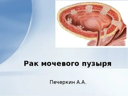 Ответы на тесты нмо рак мочевого пузыря