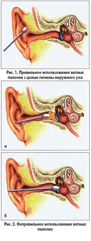 Серная пробка на барабанной перепонке.