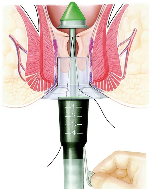 Snore stopper в нос. Инструменты для прохождения и расширения корневых каналов. Расширив проход. Расширив проход. Усиление проемов толщиной 580 мм металлической обоймой.