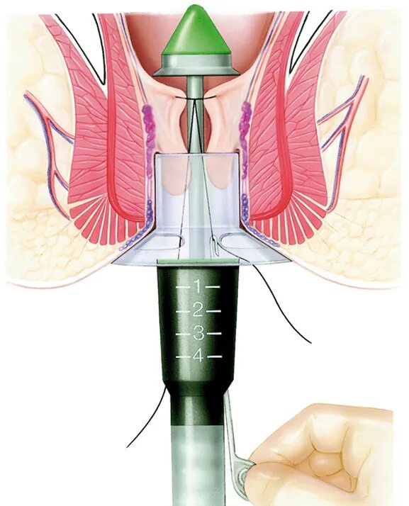 Геморроидопексия операция Лонго. Степлерная геморроидэктомия операция Лонго. Пневмодивульсия сфинктера. Тромбированный наружный геморроидальный узел. Расширив проход