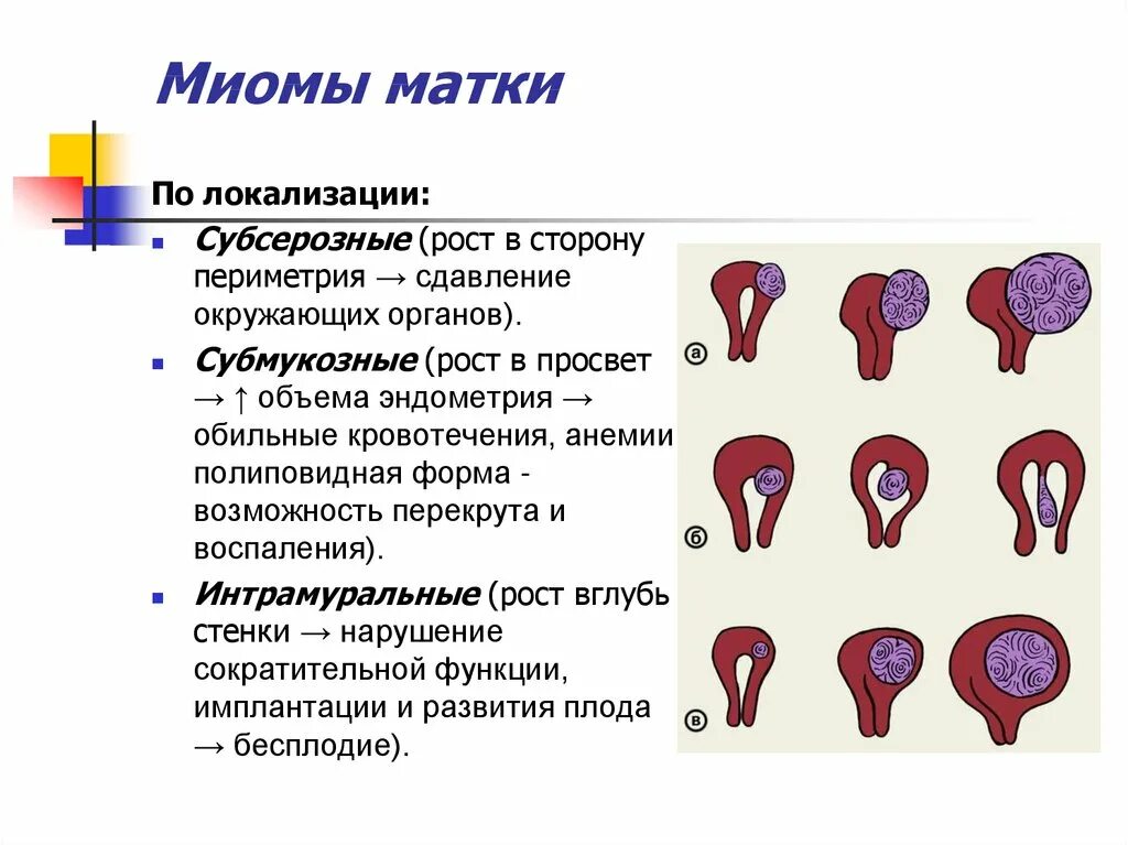 Узловая миома матки 33мм. Типы субсерозной миомы матки. Типы роста миоматозных узлов.. Миома шеечной локализации.