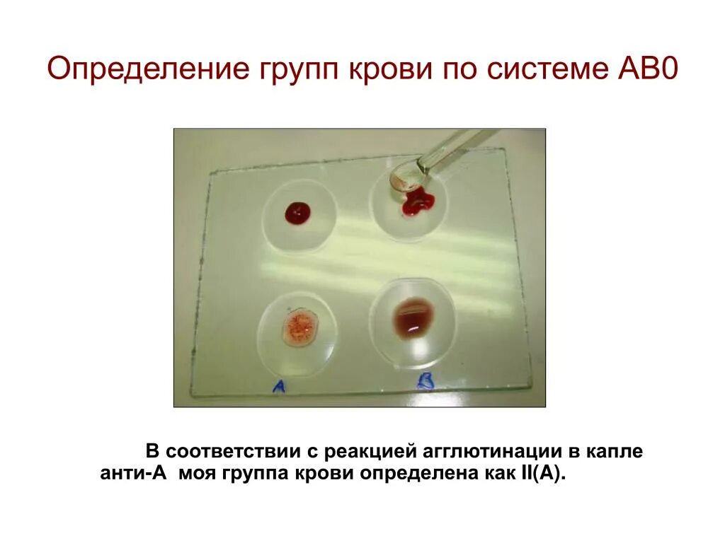 2 группа крови определение. Агглютинация по группам крови. Определение группы крови. Реакция определения группы крови. Методика определения группы крови.