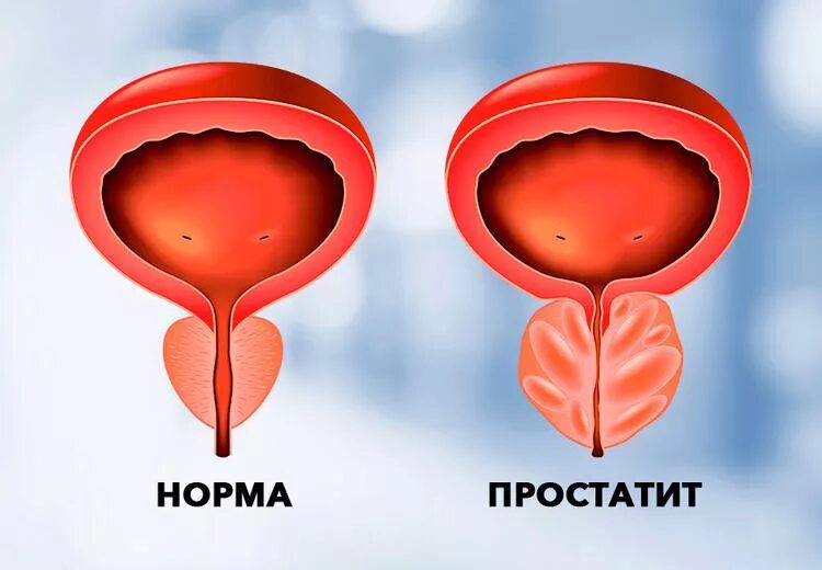 Простатит у детей. Простатит рисунок.