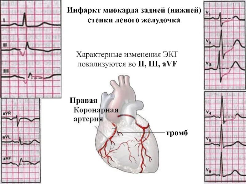 Изменение миокарда задней. Инфаркт миокарда нижнебоковой стенки. острый инфаркт миокарда нижней стенки на экг. старый инфаркт миокарда передней стенки экг. инфаркт нижнебоковой стенки на экг.