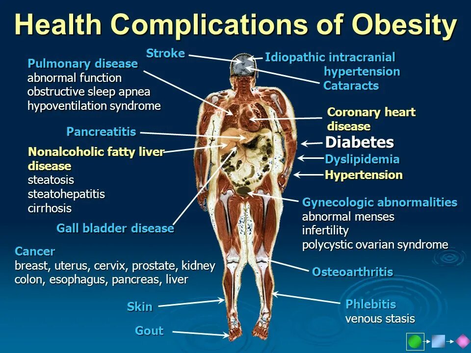 Complications of obesity. Obesity hypoventilation Syndrome. Obesity Epidemiology. Obesity diseases. Diseases associated