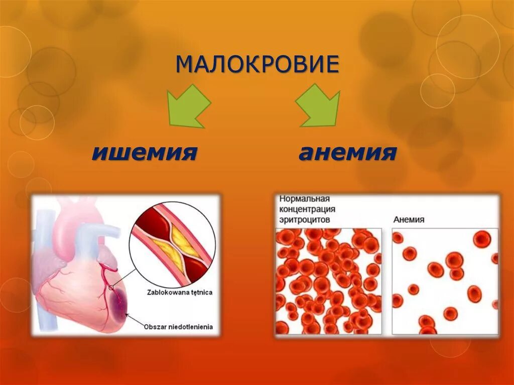 Малокровие болезнь крови. Малокровие у человека возникает вследствие. Малокровие причины возникновения. Малокровие у человека возникает вследствие. Малокровие у человека возникает вследствие.