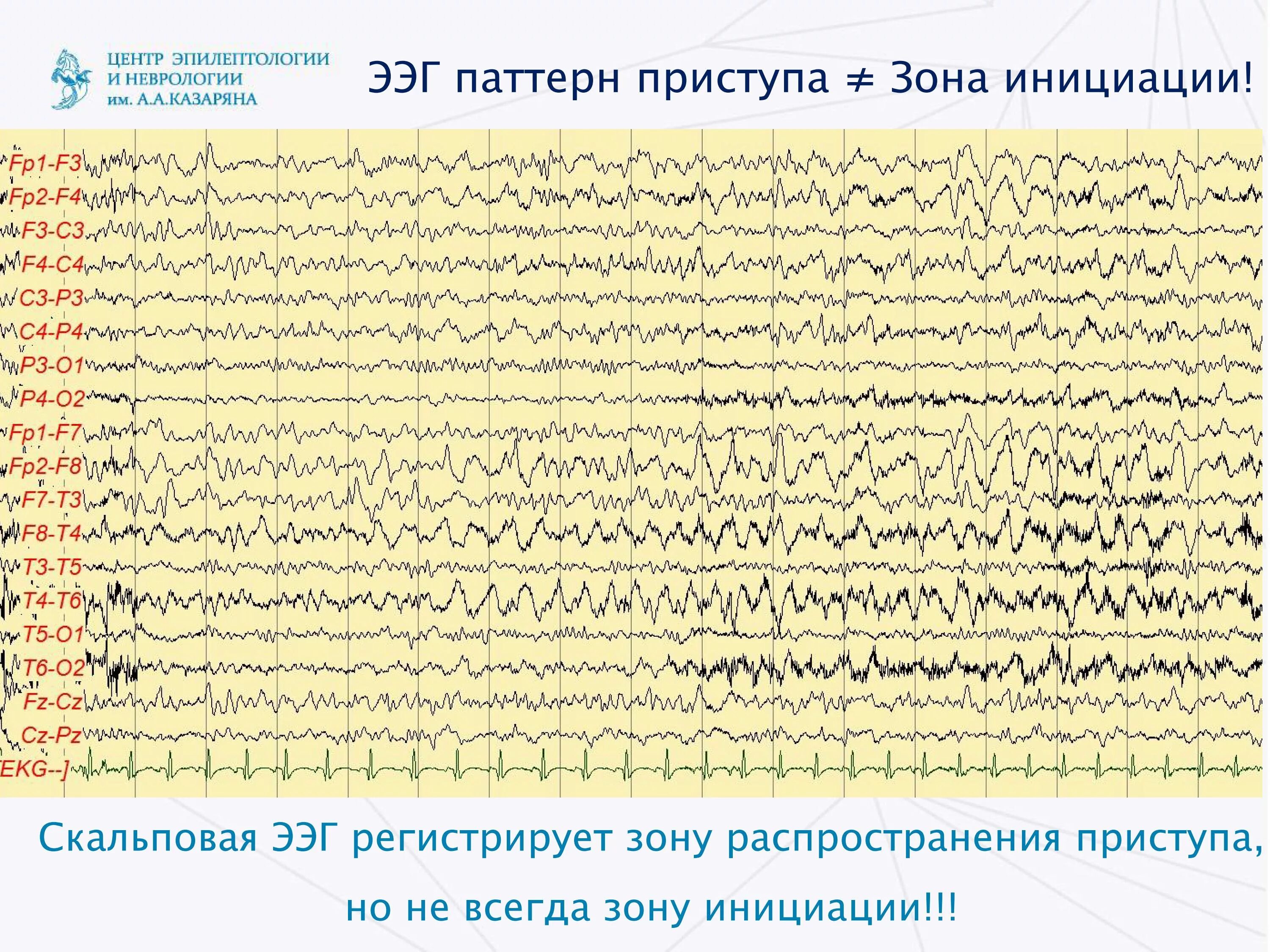 Ээг красноярск. Центр эпилептологии и неврологии имени Казаряна. Лямбда волны на ЭЭГ. ЭЭГ запись. Результаты ЭЭГ.