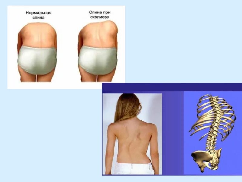 Нормальная поясница. Спина нормальная человеческая. Как выглядит нормальная спина. Поясница нормального человека. Спина и вид нормального человека.