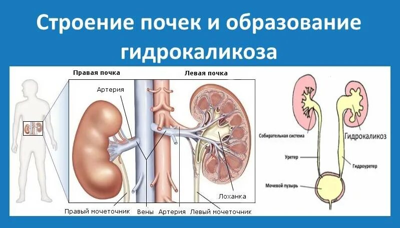 Заболевание почек гидронефроз. Гидрокаликоз левой почки на УЗИ. Гидрокаликоз чашечки почек. Гидрокаликоз правой почки. Гидрокаликоз почек патанатомия.