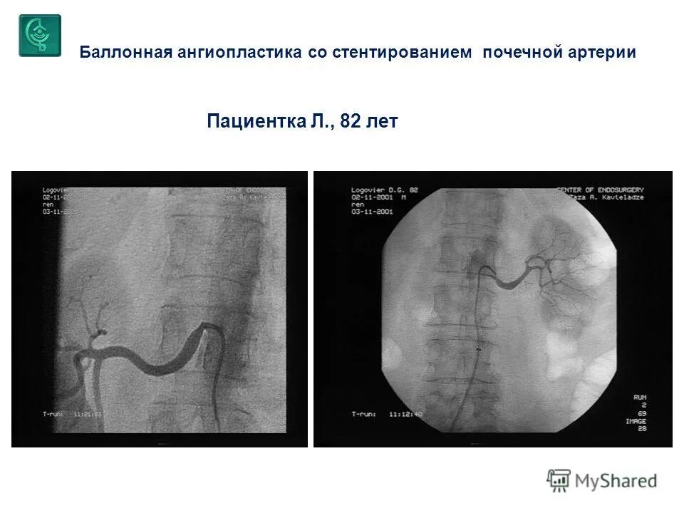 Ангиопластика сосудов нижних