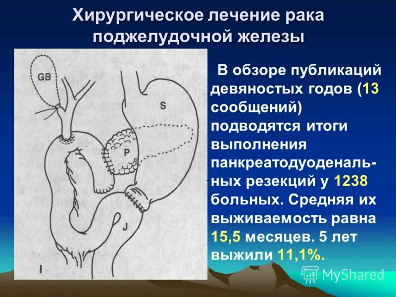 Рак поджелудочной 4 стадия как умирают. Операция на поджелудочной железе и мобилизация. Опухоль головки поджелудочной железы 4 стадии. Рак поджелудочной 4 стадия как умирают. Опухоли поджелудочной железы эпидемиология.