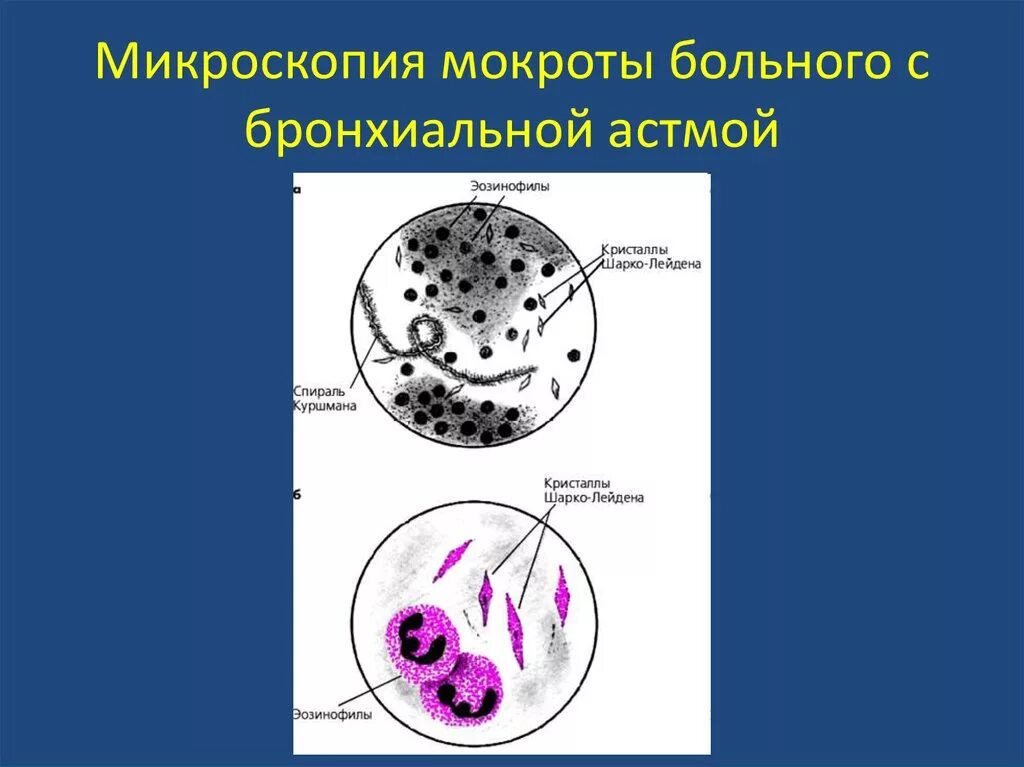 В мокроте можно обнаружить. Исследование мокроты при бронхиальной астме. Бронхиальная астма микроскопия мокроты. Микроскопическое исследование мокроты при бронхиальной астме. Эозинофилы в мокроте микроскопия.