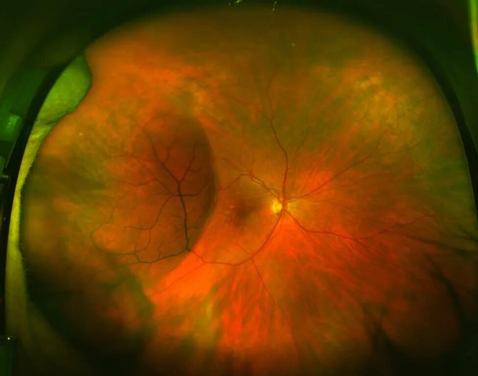 Заболевания сосудистой оболочки. Ретиношизис дистрофия сетчатки. Периферический дегенеративный ретиношизис. Кистовидный ретиношизис.