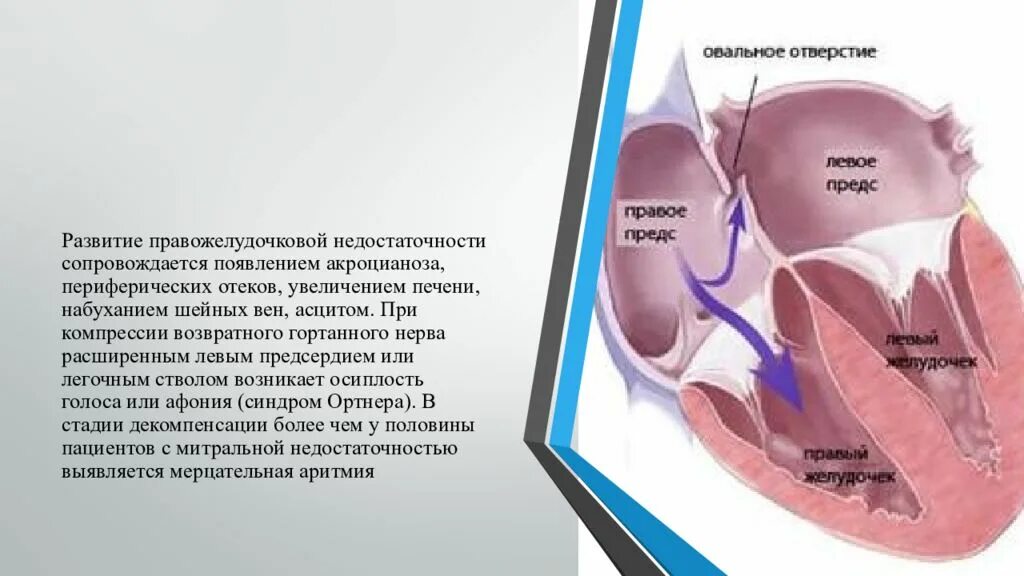 Недостаточность предсердия. Тема недостаточность митрального клапана. Правожелудочковая недостаточность. Осиплость голоса при митральной недостаточности. Периферический отек правожелудочковая недостаточность.