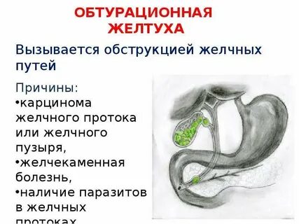 Обструкция желчевыводящих путей что это