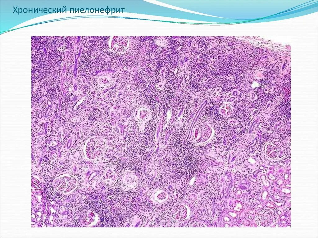 Пиелонефрит микропрепарат. Хронический пиелонефрит патанатомия микропрепарат. Пиелонефрит гистология. Гнойный пиелонефрит гистология. Межуточное воспаление микропрепарат.