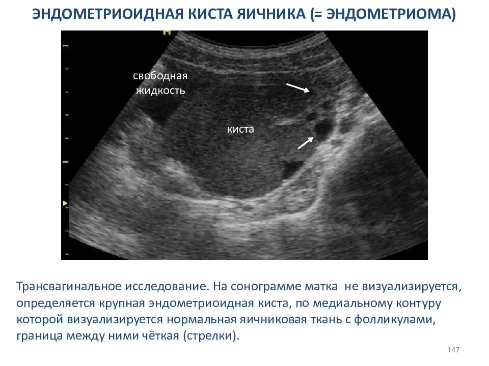 Какая норма кисты. Эндометриоидная киста на УЗИ описание. Эндометриозные кисты яичника. Эндометриоидные кисты яичников УЗИ.