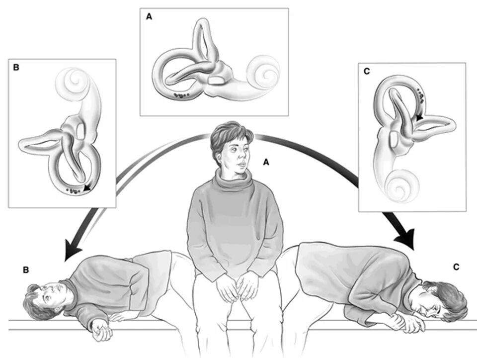 Брандта Дароффа. Гимнастика Брандта Дароффа. Гимнастика вестибулярного аппарата Брандта Дароффа. Маневр Брандта-Дароффа.
