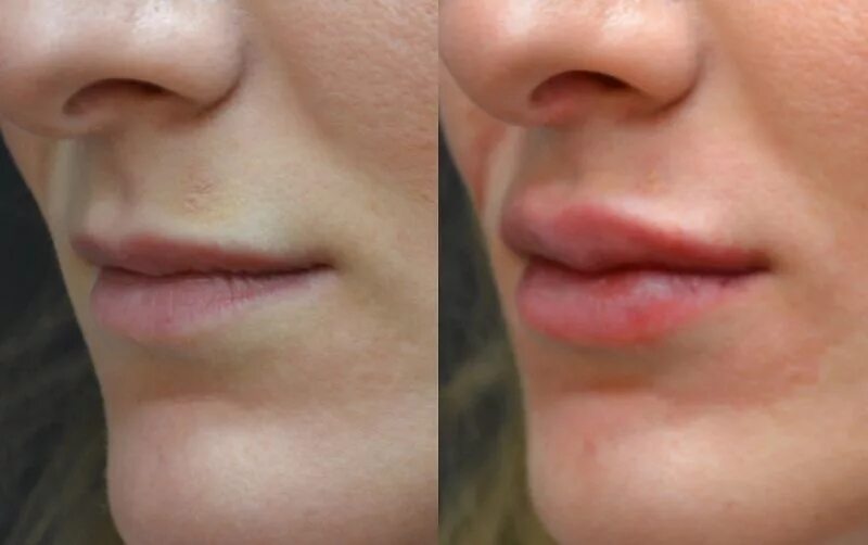 Увеличение губ lips. Коррекция губ. Губы после контурной пластики.