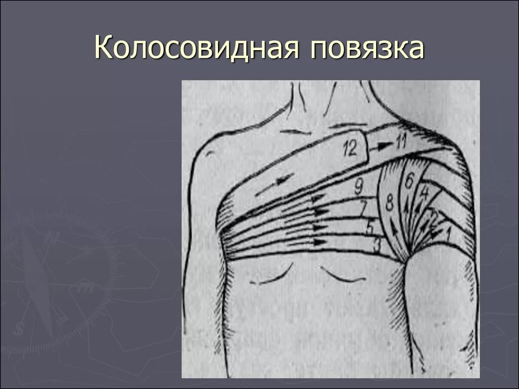 Плечевая повязка алгоритм. Колосовидная повязка техника. Колосовидная повязка на плечевой сустав алгоритм. Наложение колосовидной повязки на плечевой сустав. Колосовидная повязка показания.