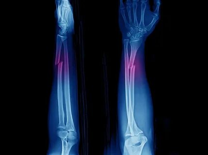 Open fracture