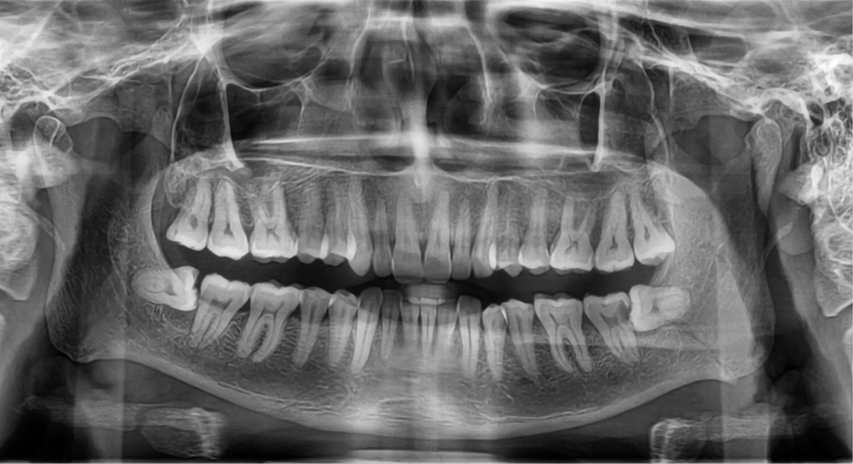 Зуб 8 нижний. Ретинированный зуб мудрости на нижней челюсти. Перикоронарит рентген.