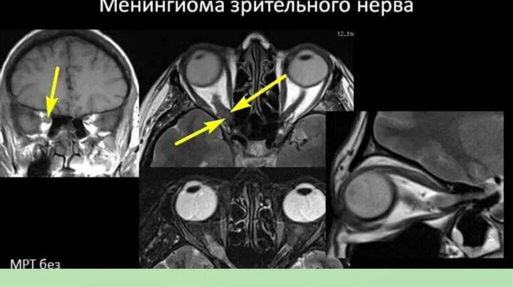 Мрт глазного нерва. Менингиома зрительного нерва кт. Глиома зрительного нерва мрт. Менингиома зрительного нерва мрт. Глиома зрительного нерва на кт.