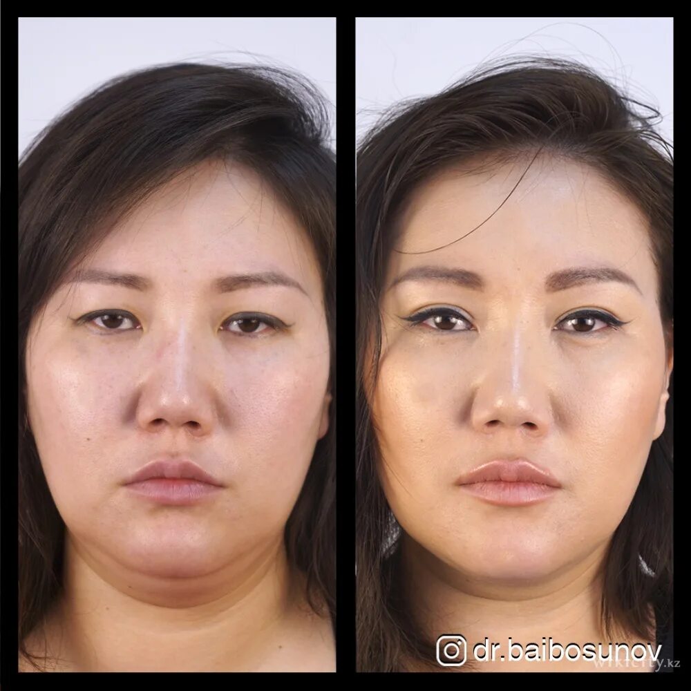 Лица алматы. Казашка лицо. Цена на подтяжку лица в корее. Лица алматы. Эпикантопластика.