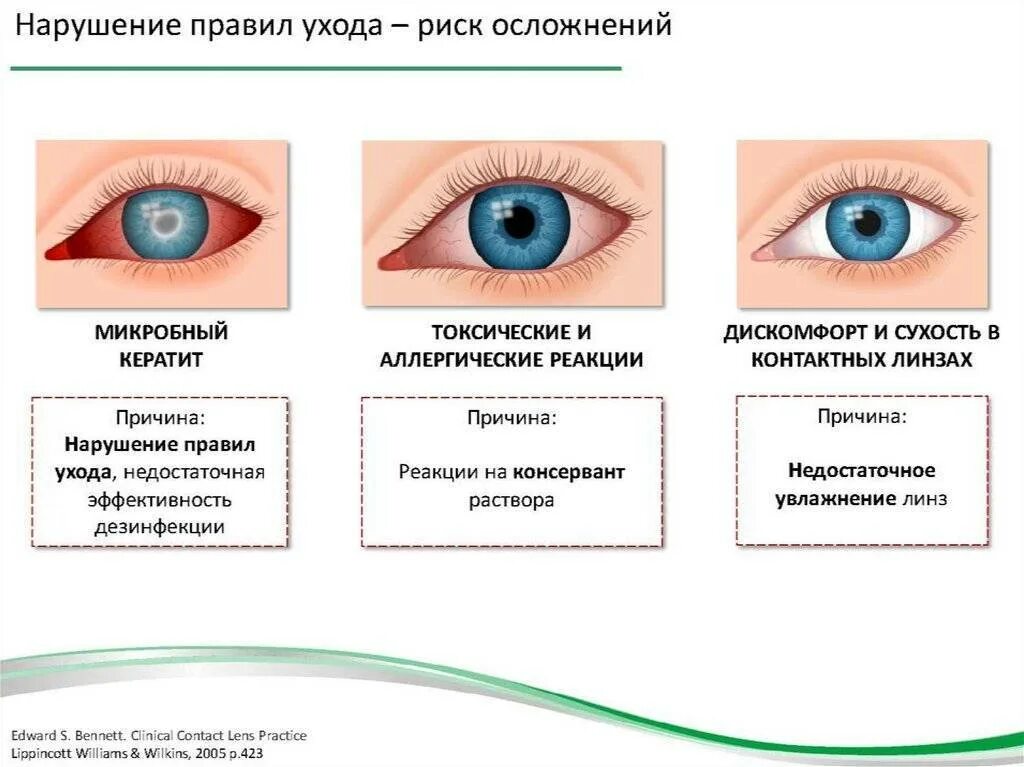 Линзы при сухости глаз. Синдром сухого глаза памятка. Симптомы чиндрома сузого новща. Синдром сухого глаза симптомы.