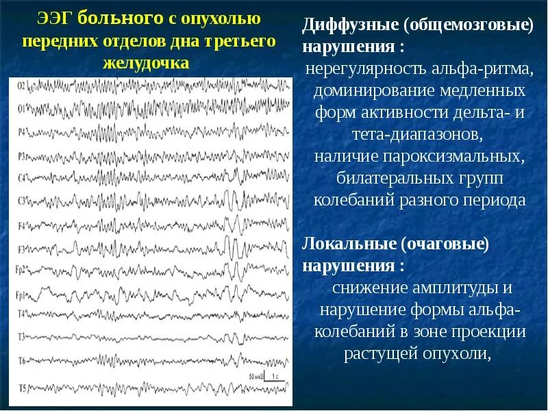 Расшифровка показателей электроэнцефалограммы ЭЭГ головного мозга. Альфа ритм на ЭЭГ норма. Дельта активность на ЭЭГ У взрослых. Биоэлектрическая активность головного мозга. Ритмы ЭЭГ.. Диффузный характер головного мозга