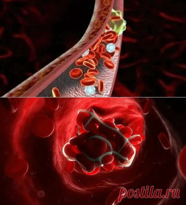 Профилактика тромбозов артерий. Предотвращение тромбов