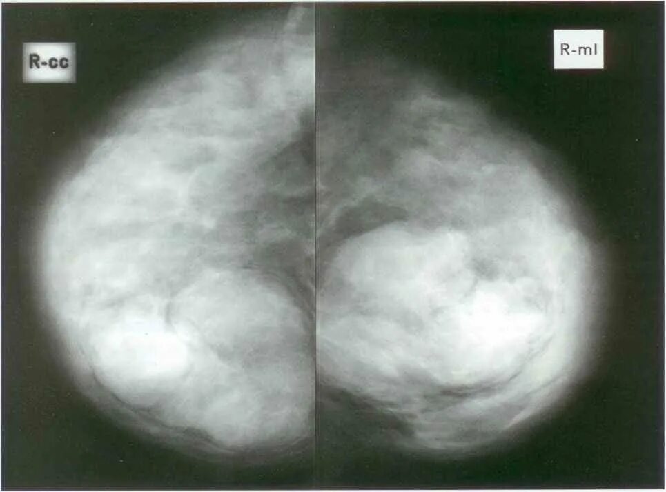 Маммограмма фиброаденома. Филлоидная опухоль молочной железы. Маммография фиброаденома. Фиброаденома молочной железы маммография. Доброкачественная железистая опухоль