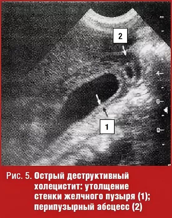 Паравезикальная клетчатка. УЗИ картина деструктивный холецистит. Перивезикальный абсцесс желчного пузыря. Перивезикальный инфильтрат.