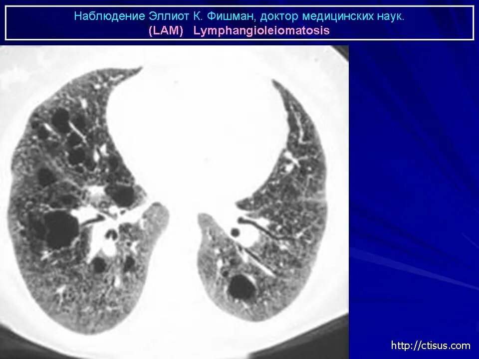 Пневмосклероз это простыми словами. Лимфангиолейомиоматоз легких кт. Пневмосклероз легких кт. Постпневмонический пневмосклероз.