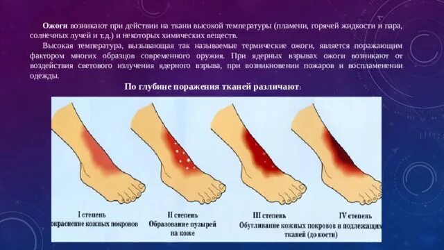 Ожоги бывают виды. Ожоги, эффекты воздействия высоких температур, теплового излучения. Первая помощь при ожогах и воздействии высоких температур. Ожоги по степени тяжести первая помощь.