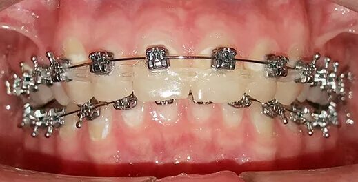 Брекеты h4 самолигирующие металлические. Самолигирующие h4. Система н4. Система н4. Система н4.