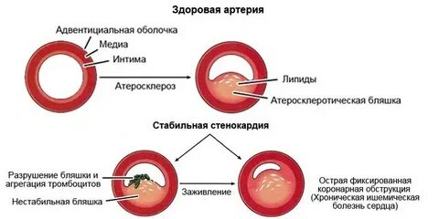 Проверить бляшки