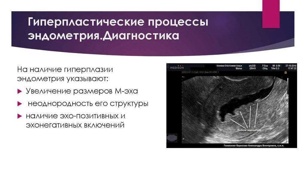 Гиперплазия это эндометриоз. Железистая гиперплазия эндометрия узи. Железистый полип эндометрия на узи. Гиперплазия это эндометриоз. Очаговая гиперплазия эндометрия мрт.