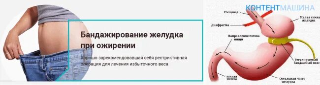 Бандажирование желудка операция. Операция по уменьшению желудка. Операция по уменьшению желудка название.