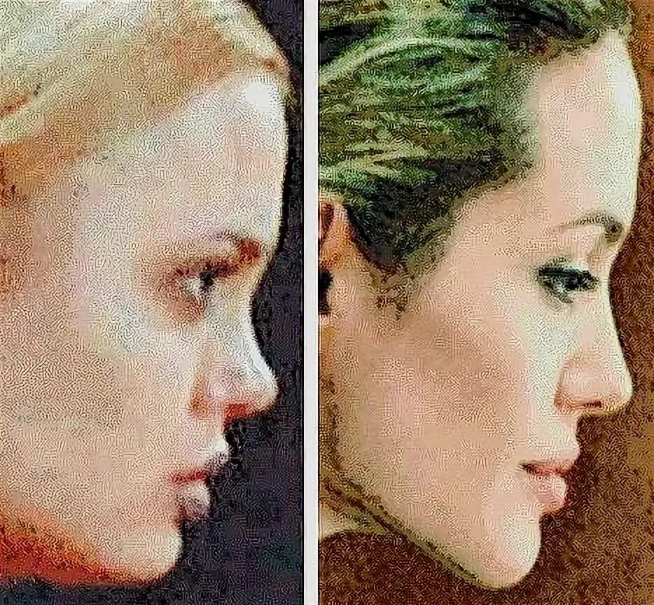 Плоский подбородок. Острый подбородок. Ментопластика челюсти. Как сделать подбородок острым. Как сделать подбородок острым.