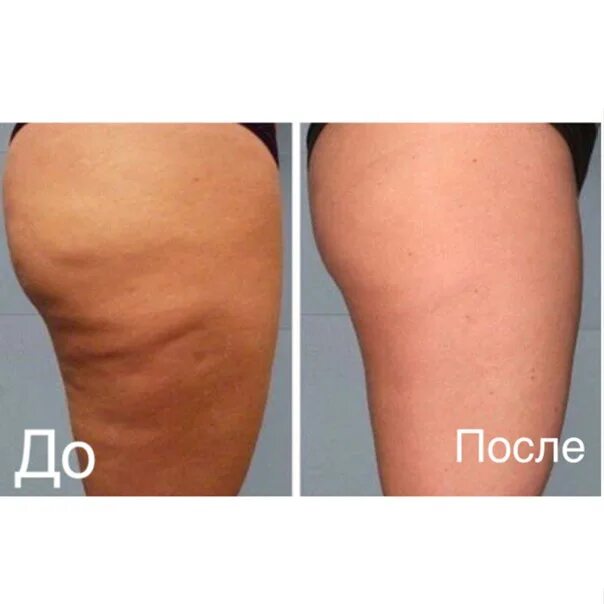 Липолитики Dr.Lipo. Dr Липо + липолитики. Dr. Lipo липолитики тело. Эффект от липолитиков в бедра. Липолитик стройность отзывы